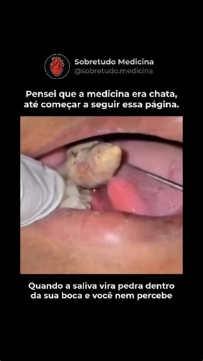Sobretudo Medicina | Saúde | Curiosidades on Instagram: "O cálculo salivar, também chamado de sialólito, é uma massa calcificada que se forma dentro das glândulas salivares ou em seus ductos. Ele surge quando a saliva, rica em minerais como cálcio e fosfato, tem seu fluxo reduzido, situação comum em casos de desidratação, boca seca, uso de certos medicamentos ou infecções, permitindo que esses minerais se cristalizem progressivamente. Quando o ducto salivar fica obstruído, a saliva se acumula e 