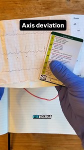 4.3K views · 417 reactions | Axis deviation simplified Learn. Adapt. Respond. #ecg #paramedics #paramedicstudent #axisdeviation #nursestudent #medicaleducation | The Medical Lounge | Facebook