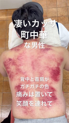【首肩周り強い凝り！】カッサでお剥がし‼️
