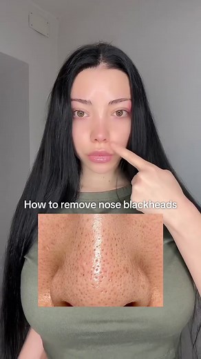 Effective Ways to Remove Nose Blackheads