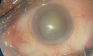 Superior Oblique Intorsion - Eyetube