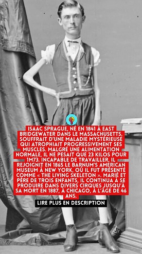 L’histoire fascinante et tragique d’Isaac Sprague, surnommé « le squelette vivant ». Né en 1841 dans le Massachusetts, cet homme souffrait d’une mystérieuse maladie qui dévorait lentement ses muscles. Malgré un appétit normal, il ne pesait que 23 kilos pour 1m73 ! Incapable de travailler comme ses contemporains, Isaac Sprague devint une véritable curiosité au XIXᵉ siècle. Engagé dès 1865 par le célèbre Barnum’s American Museum de New York, il attira des foules entières, intriguées par sa silhoue