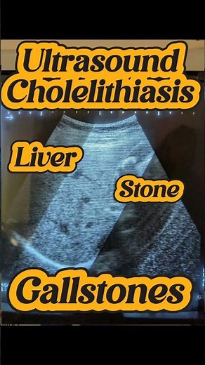 How to Ultrasound Gallstones | Cholelithiasis Ultrasound | Gallbladder Liver Scan