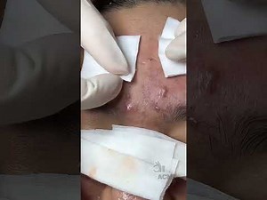 Inflamed Acne and Blackhead Removal Close-Up