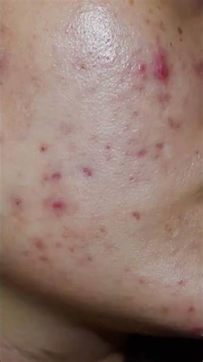 This skincare combo changed everything #acnetreatment #glow #routine