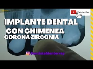 🔩 Dental Implant 👅 Impression and Zirconia Crown