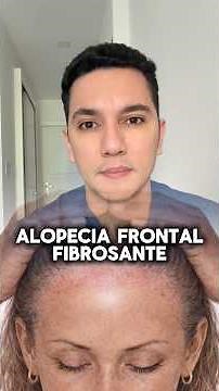 Hair loss in women after menopause (frontal fibrosing alopecia). #dermatology
