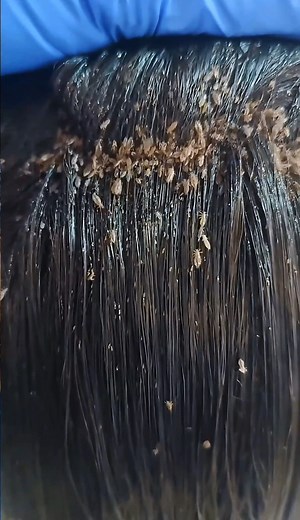 Removing lice using a bamboo tool shaped like a nail #RemovingLice #Lice #Asmr #Kuto #HairTreatment #Piojos #AntiLice | Ahmad