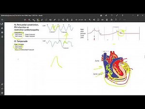 11 JVP in Constrictive Pericarditis & Cardiac Tamponade