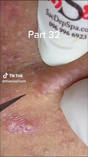 Crazy Satisfying Blackheads whiteheads Removing pimple popping 💫 How to remove blackheads and Whiteheads from nose and face naturally at home,how to remove blackheads in 5 minutes,how to remove blackheads at home instantly,how to remove blackheads from nose permanently,blackheads removal mask,clay mask for blackheads,how to remove blackheads with toothpaste,how to remove blackheads with vasline,how to remove deep blackheads at home,how to remove blackheads on nose at home,how to remove blackhea