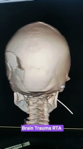 CT scan VR image of the brain showing traumatic injury. #braintech #hospital #radiology
