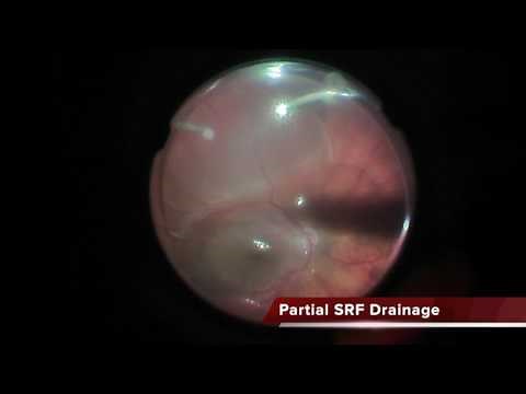 Iatrogenic Macular Translocation and Fold / Translocación Macular Iatrogenica con Pliegue Macular