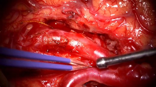 AVMs are endlessly variable, which is why taxonomy simplifies the confusion to 32 recognizable subtypes, each w/definable anatomy & surgical strategy. Types are the lobes/brain regions, subtypes are surfaces on which the nidus is based. Taxonomy informs learning, guides resection…