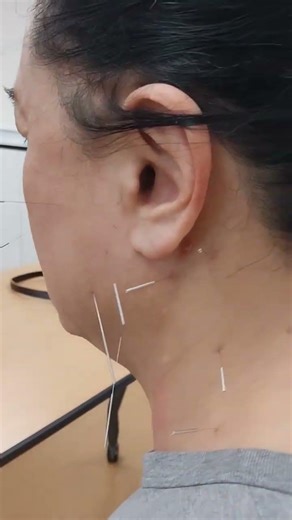 경부와 접형골 침법. 사각근 측두근 교근 익상근 하악관절. 소나무한의원 영등포구 문래로 92 5층 02-2637-8142.3 010-2323-6088