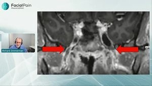 Trigeminal Neuralgia: Surgical Treatments - Know Your Options!