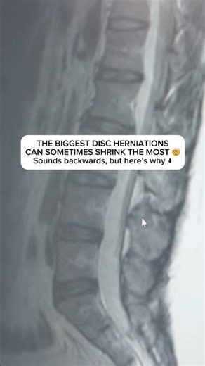 The WORST Disc Herniations Can Actually Shrink the Most 🤯