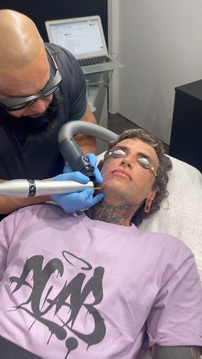 Making remarkable progress on this massive transformation! We started with thick layers of ink and heavy scarring but as you can see, the ink is clearing beautifully and we’re managing to improve a lot of the scarring as well! 💥🙌💫 We’re loving being a part of this journey with @ethanmodboybramble - gorgeous inside and out!! 🤩🥰🔥 . . #tattoos #inked #beforeandafter #skin #facetattoo #tattooremoval #journey #progress #lifechanging #love #wow | ERAZE clinic