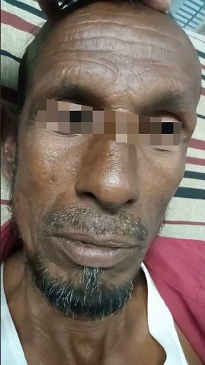 Hatchet face || Triangular face || Myotonic Dystrophy