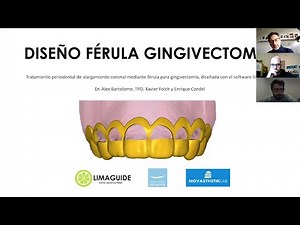 Férula gingivectomia