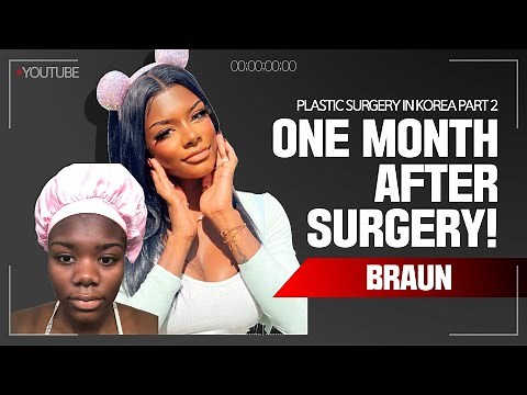 Jaylyn's (ethnic nose job) Rhinoplasty and Facial Contouring Surgery recovery timeline - One month!