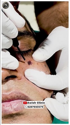 Safe Mole Removal: Step-by-Step Procedure and Aftercare Guide" Awish Clinic