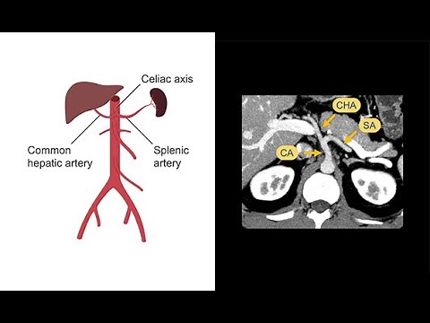 Evaluating the abdominal arteries (aorta) with the help of CT