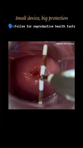 What Is IUD? | Intrauterine Device #youtubeshorts #medicalshorts #medicalreels