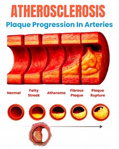 Atherosclerosis develops over decades: Fatty Streak → Atheroma → Fibrous Plaque → Plaque Rupture Most acute events arise from vulnerable plaque biology, not stenosis severity. This is why we treat the plaque, not just the narrowing. 🔑: Focus on plaque stabilization—via aggressive LDL-C lowering and inflammation control—not just stenosis reversal. Essential for risk stratification, preventive therapy, and explaining “why early prevention matters” to patients. @cardiovisual ✨ #Cardiology #Atheros