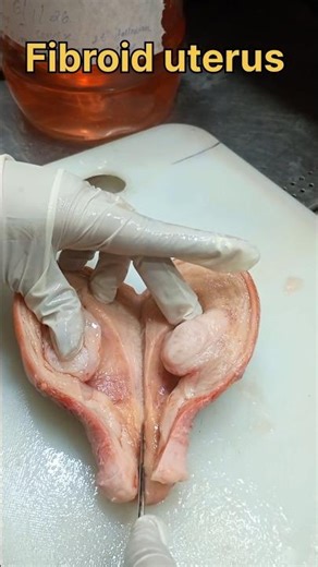 Fibroid uterus specimen 🤔| #histopathology #histomuseum #uterineprolapse #fibroidremoval #uterus