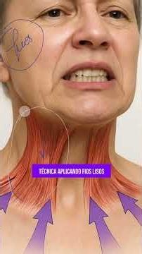 Thread technique for platysma myomodulation