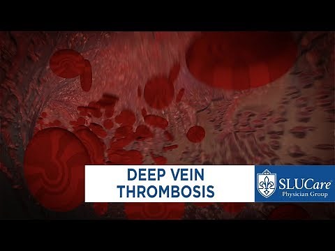 Treating Deep Vein Thrombosis - SLUCare Vascular Surgery