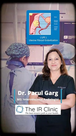 Uterine Artery Embolization Case Study 🌸 Fibroid Treatment Without Major Surgery