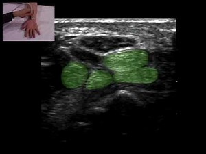 Musculoskeletal Ultrasound: Wrist 1: volar transverse scan