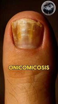 Onychomycosis: a fungal infection of the nail. #medicine #healthtips #healthandwellness #shorts