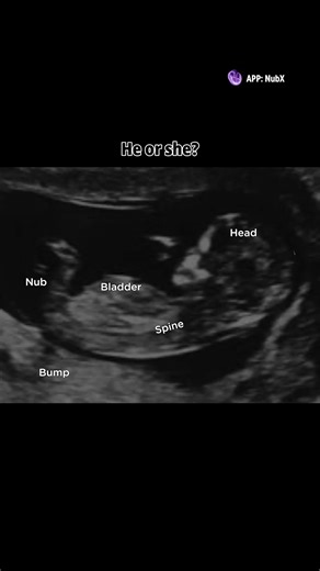 Understanding Gender Reveal Ultrasound Predictions