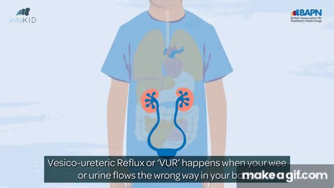 What is vesicoureteral reflux (VUR)? | Kidney disease | infoKID on Make a GIF