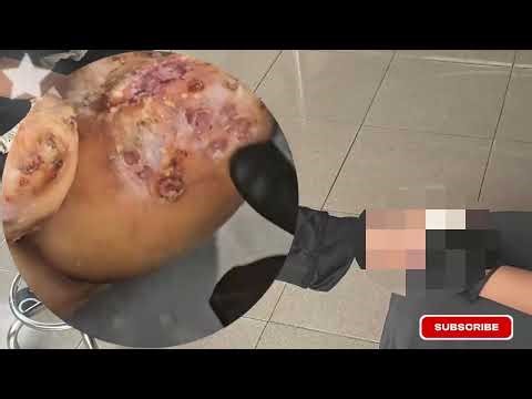 ⚠️ Extreme Jigger Infestation – Cracked Skin Peeled Off Clean! #NT355