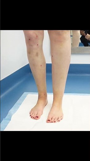 Halfway Through LIVE Surgery | Immediate Results | Awake 360° Liposuction | Cankles & Knees | Dr. Su