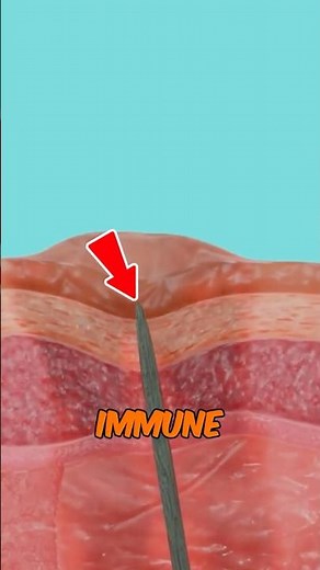 WHAT HAPPENS When A Splinter Gets Stuck Under Your Skin?