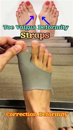 Toe deformity correction home straps use daily ! #correction #trend #feed #shortsfeed #viralshort