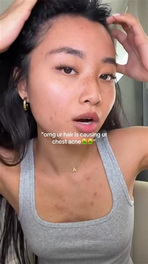 ALLIE CHEN on Instagram: "my chest acne has gotten better ever since that out break so YAYYY #acneproneskin #bodyacne #hairstyles #slickbackbun"