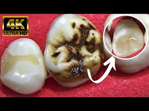 AMAZING Reconstruction of Tooth Destroyed by Caries - Endodontic Treatment in 4K
