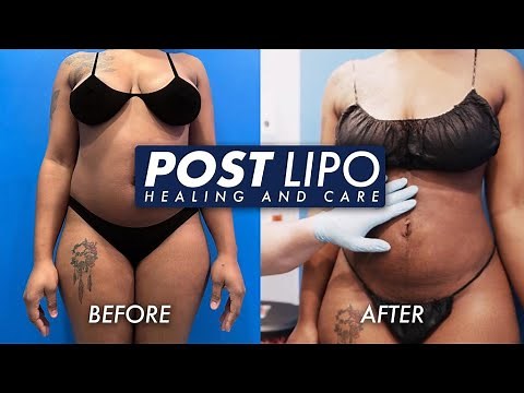 Post Liposuction Healing and Care