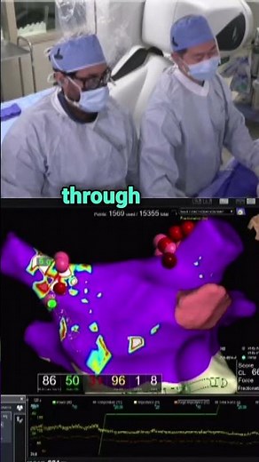 Cardioneural ablation in action ⚡