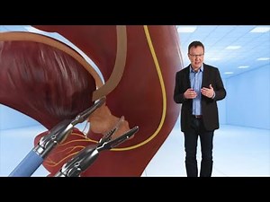 SWR Gesundheitscoach erklärt: robotergestützte Prostata-OP