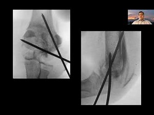 Lateral Condyle Fractures in Children : Management of fresh Fractures by Dr Manoj Padman