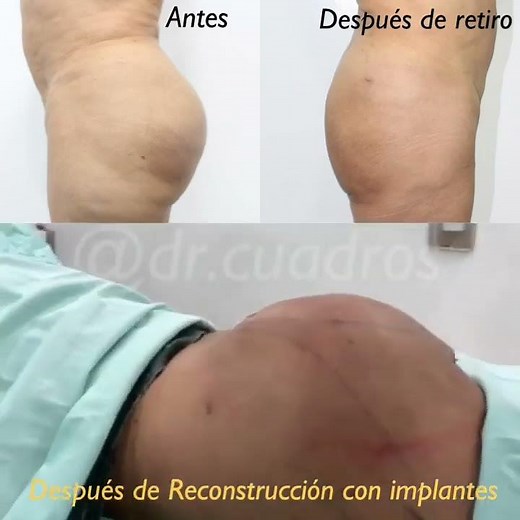 Retiro Biopolímeros en Glúteos (Hombres y Mujeres) Reconstrucción de con Implantes (Antes y Después)