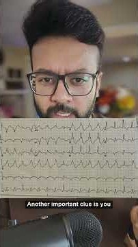 AIVR vs VT: ECG Clues in Ischemic Cardiomyopathy