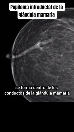 Intraductal papilloma of the mammary gland #medicine #papilloma #mammarygland #breast #gynecology