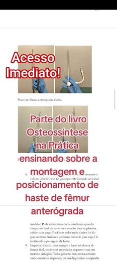 Osteossíntese na prática. #enfermagem #ortopedia #cirurgias #medico
